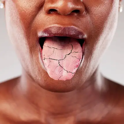 Keep Your Smile Bright & Clean With Dry Mouth in Payson