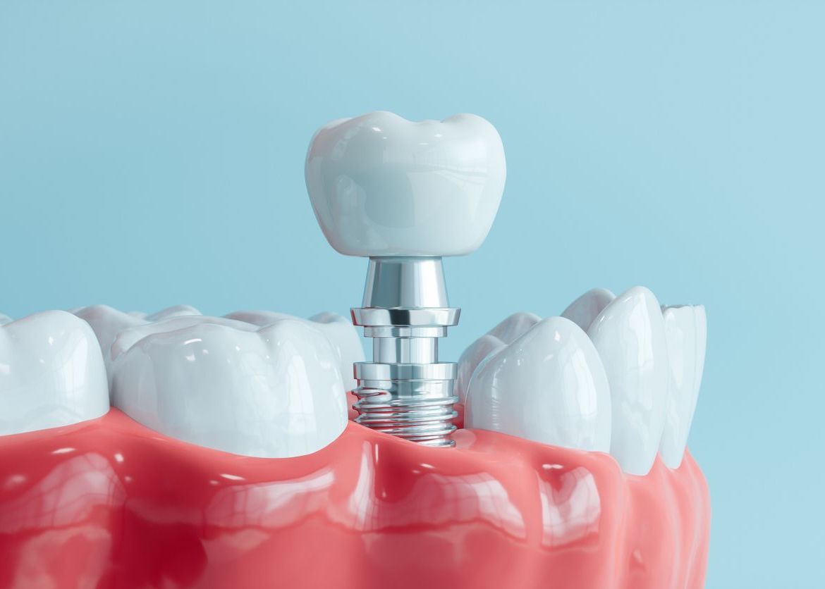 Dental Implants in Payson, UT