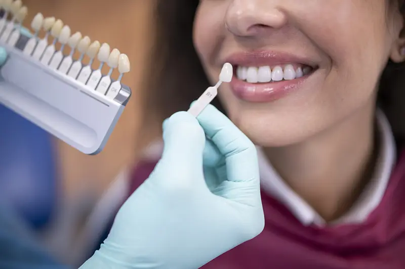 Veneers Keep Your Smile Bright & Clean With Teeth Whitening in Payson